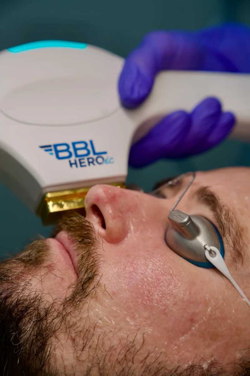 BBL HEROic photofacial at Skin Talk