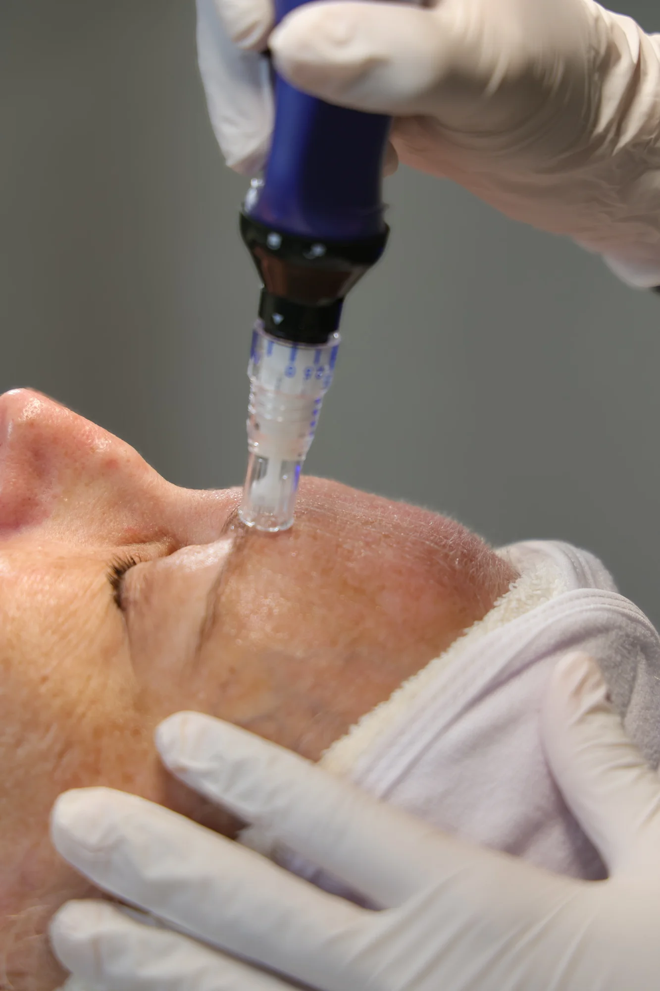 Microneedling at Skin Talk