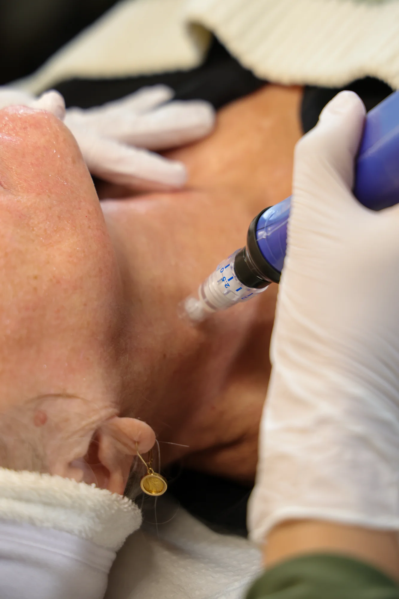 Microneedling pass along the jawline