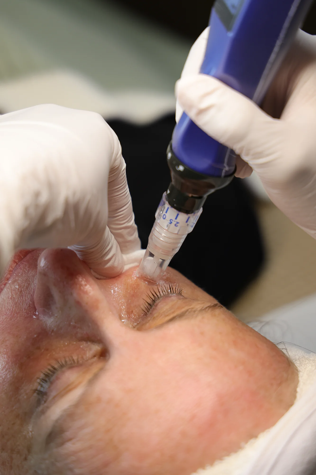 Microneedling under the eye at a shallower depth